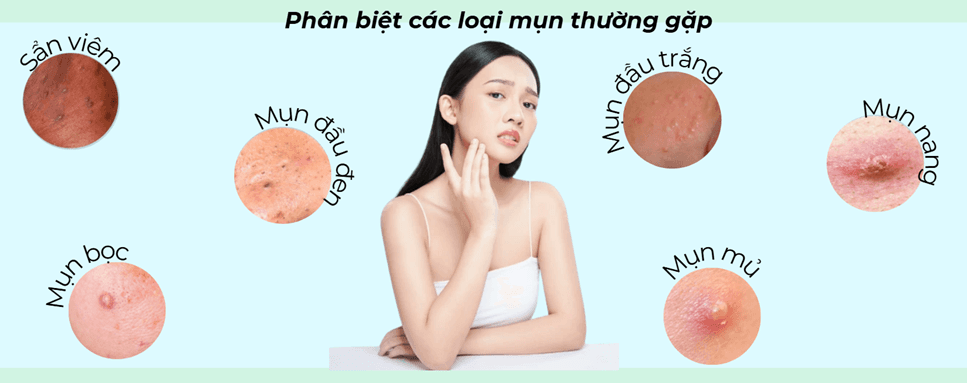 Phân biệt các loại mụn